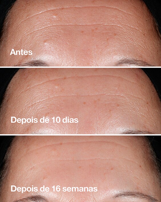 Antes e depois Sérum Anti-Idade Smart™