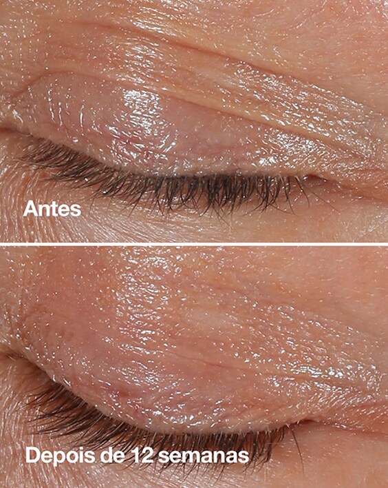Antes e depois Creme Antirrugas para olhos